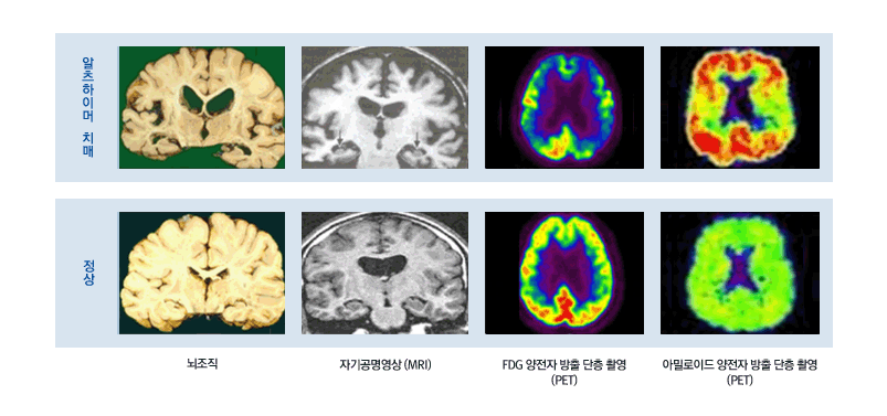 그림 - 알츠하이머 치매 뇌 영상 소견 : 알츠하이머 치매(뇌조직, 자가공명영상(MRI), FDG양전자 방출 단층 촬영(PET), 아밀로이드 양전자 방출 단층 촬영), 정상(뇌조직, 자가공명영상(MRI), FDG양전자 방출 단층 촬영(PET), 아밀로이드 양전자 방출 단층 촬영)