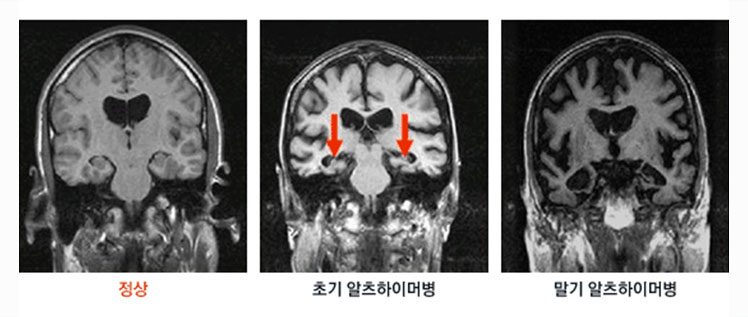 그림 - 경과에 따른 알츠하이머병 MRI 사진 : 정상, 초기 알츠하이머병, 말기 알츠하이머병