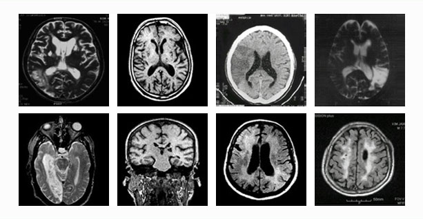그림 - 혈관성 치매 MRI 사진: FDG 양전자 방출단층 촬영(PET), 아밀로이드 양전자 방출 단층 촬영(PET)
